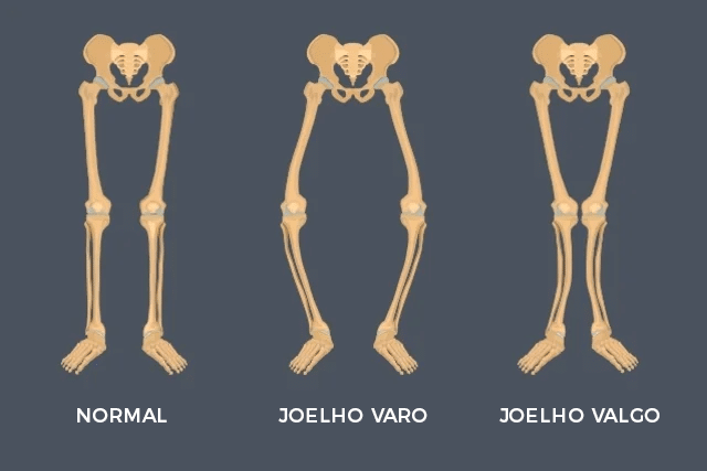 Tipos de Joelhos